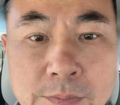 去眼袋手术