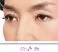 去眼袋手术