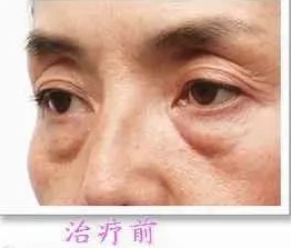 去眼袋手术