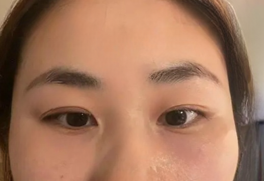去眼袋手术