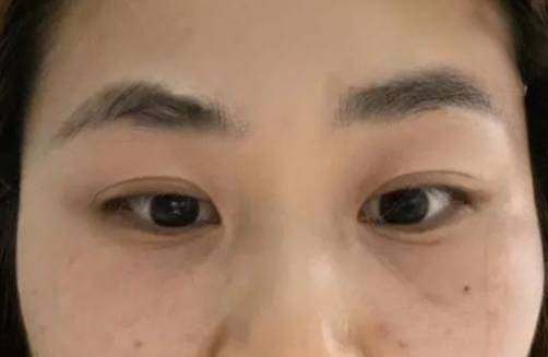 去眼袋手术