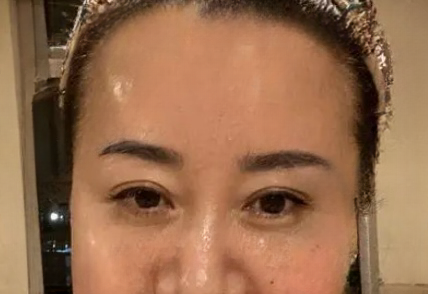 去眼袋手术
