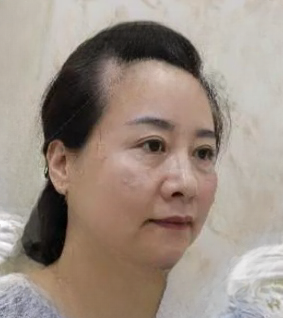 去眼袋手术