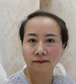 去眼袋手术