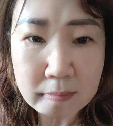 去眼袋手术