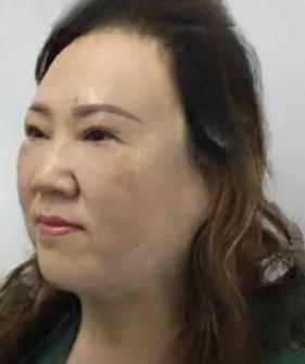 去眼袋手术