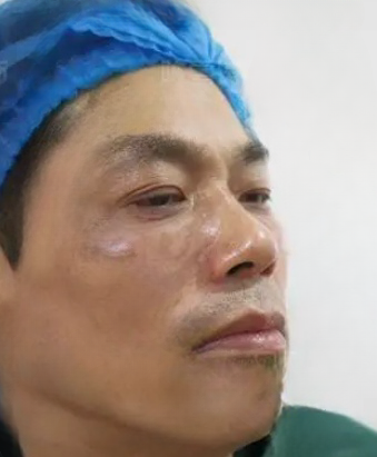 去眼袋手术