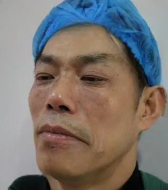 去眼袋手术