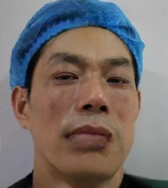 去眼袋手术