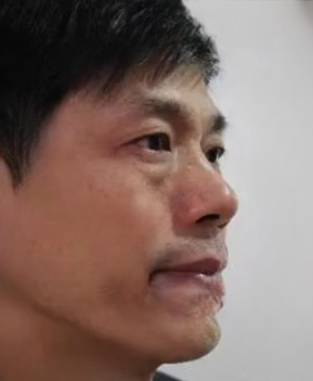 去眼袋手术