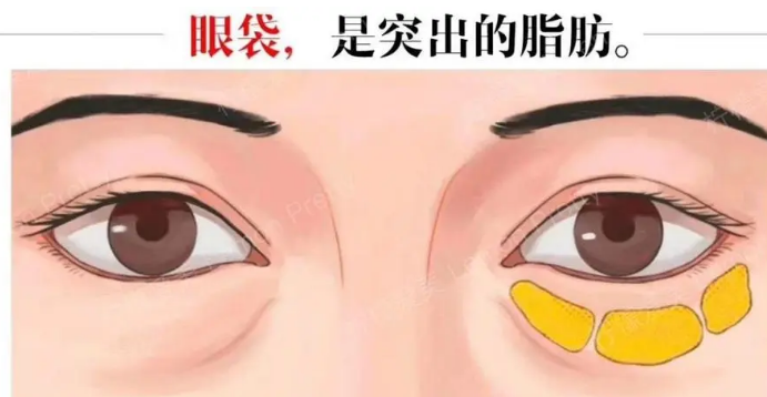 去眼袋手术