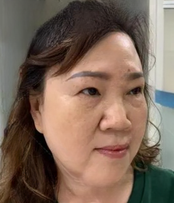 去眼袋手术