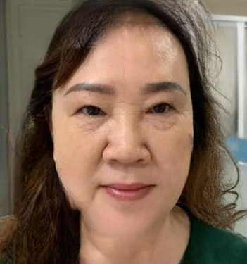 去眼袋手术