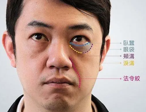 去眼袋手术