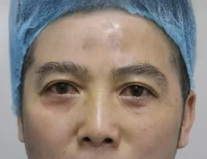 去眼袋手术