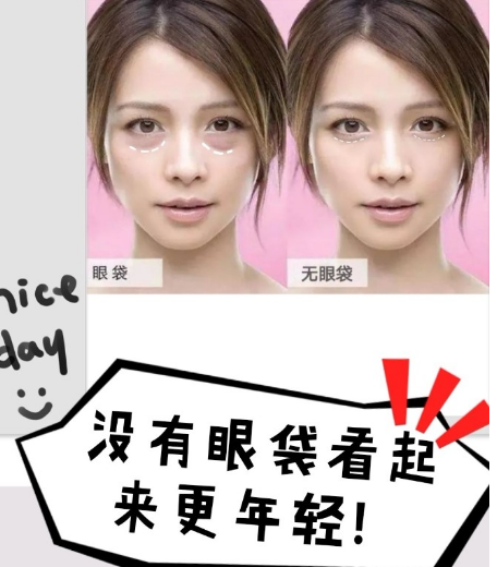 去眼袋手术