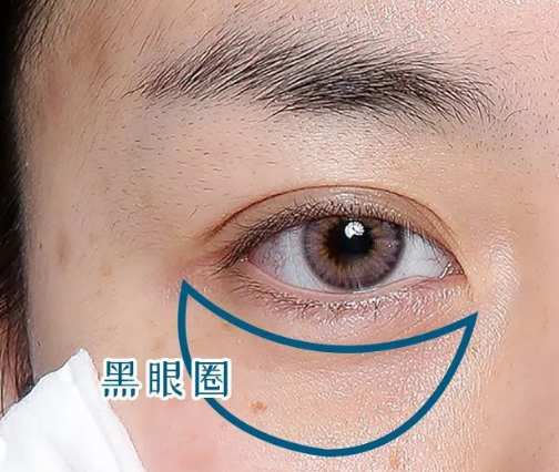 去眼袋手术