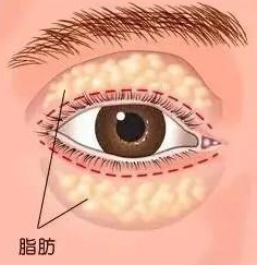 去眼袋手术