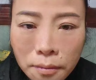 去眼袋手术