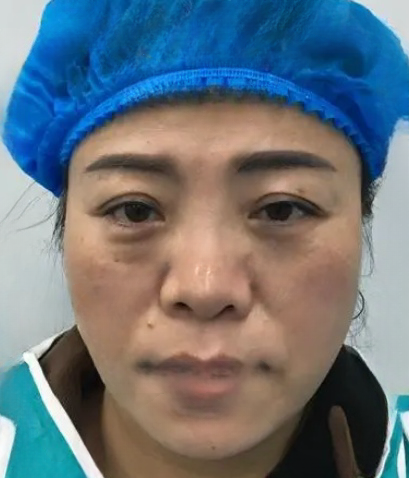 去眼袋手术