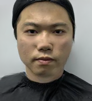 去眼袋手术