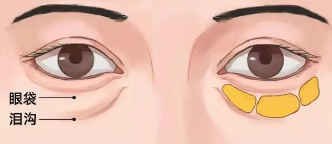去眼袋手术