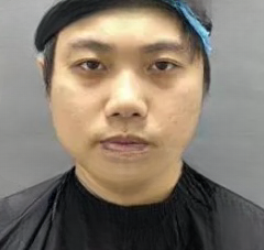 去眼袋手术