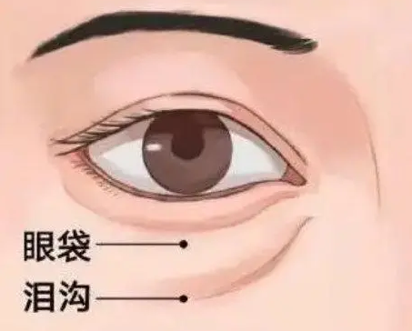 去眼袋手术