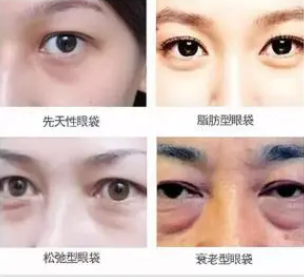 去眼袋手术