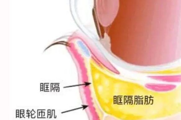 去眼袋手术