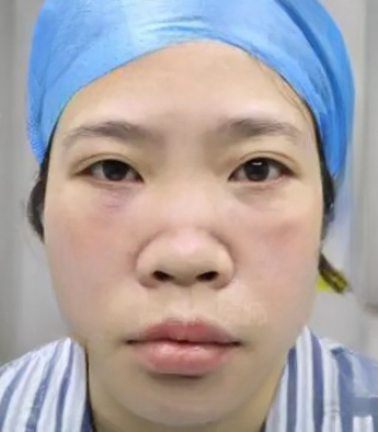 去眼袋手术