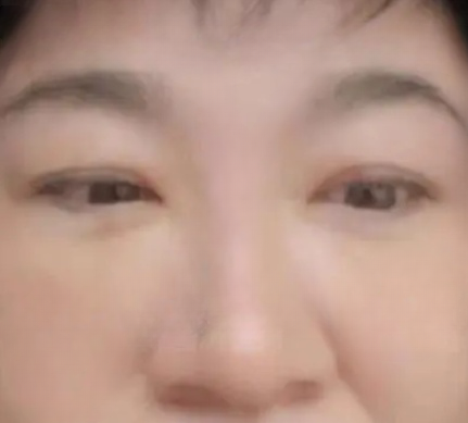 去眼袋手术