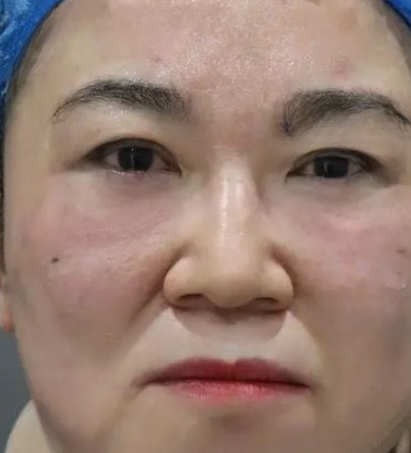 去眼袋手术