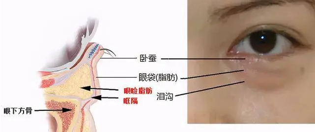 去眼袋手术
