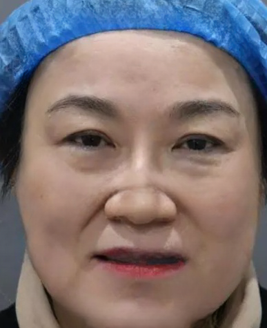 去眼袋手术