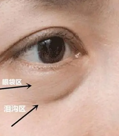 去眼袋手术