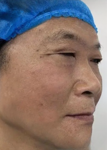 去眼袋手术