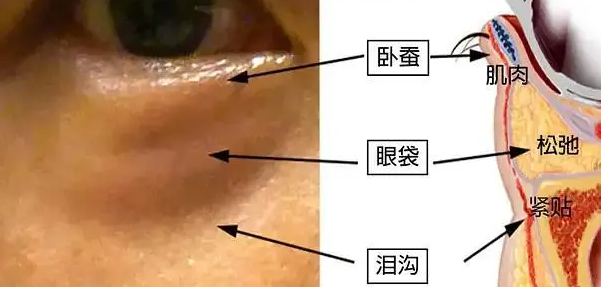 去眼袋手术