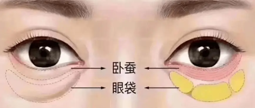 去眼袋手术