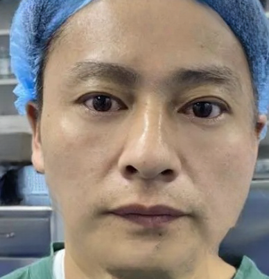 去眼袋手术