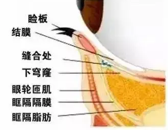 去眼袋手术