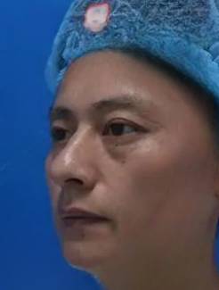 去眼袋手术