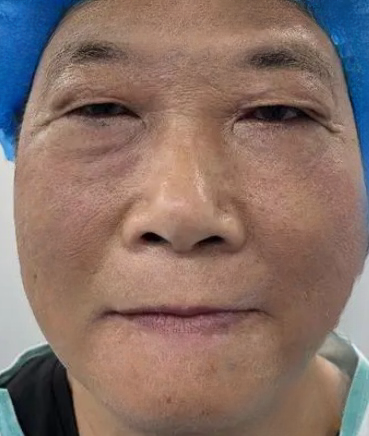 去眼袋手术