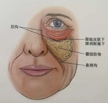 去眼袋手术