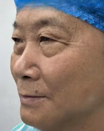 去眼袋手术