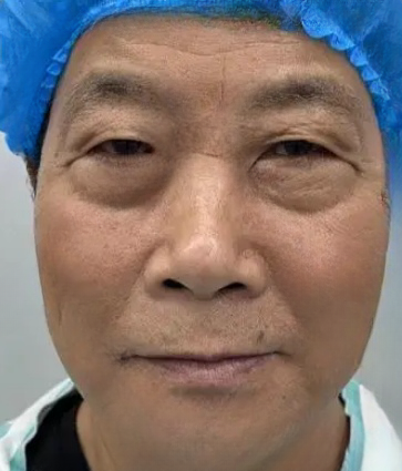 去眼袋手术