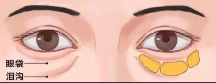 去眼袋手术