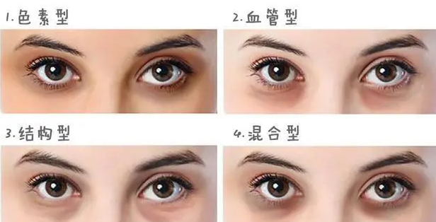 去眼袋手术