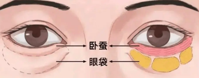 去眼袋手术