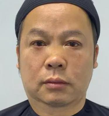 去眼袋手术
